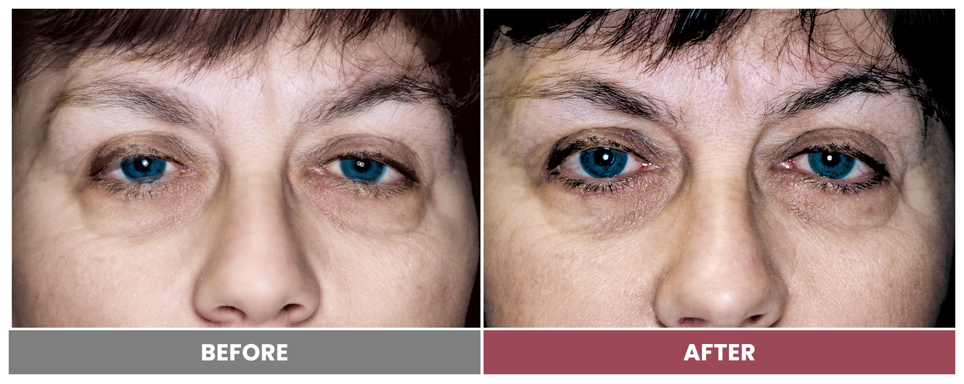 PTOSIS REPAIR - Case 2